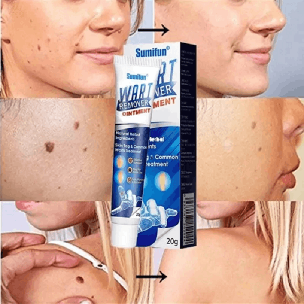 Creme WART CARE™ - Removedor de Verrugas 