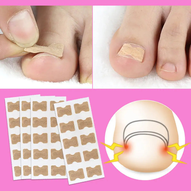 Corretor de unhas encravadas
