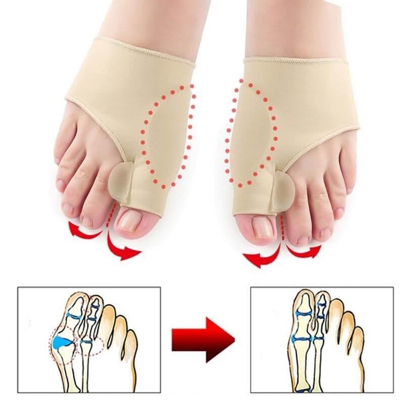 Bunion Top™ - 50% DE DESCONTO 🔥 - Corretor Ortopédico de Joanete (1 Par)