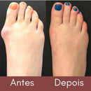 Bunion Top™ - 50% DE DESCONTO 🔥 - Corretor Ortopédico de Joanete (1 Par)